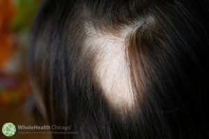 Yes, Your Child (Or You) Is Miserable With Hair Loss But Be Wary Of Big Pharma’s Latest “Gift”