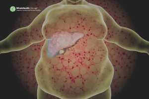 WHY THIS SUDDEN INCREASE IN “FATTY LIVER”?